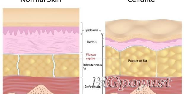 HIT-CELLULIT VIP tretman sagorevanja masnih naslaga i celulita ILI SLIM&LIFT tretman za mrsavljenje i zatezanje + UZ koktel serumi + anticelulit masaza (na dve lokacije)  2