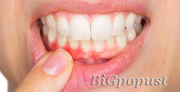 Obrada parodontalnih džepova za sve zube ( cela usta ) u Kruna Dent stomatoloskoj ordinaciji za 4000 rsd 