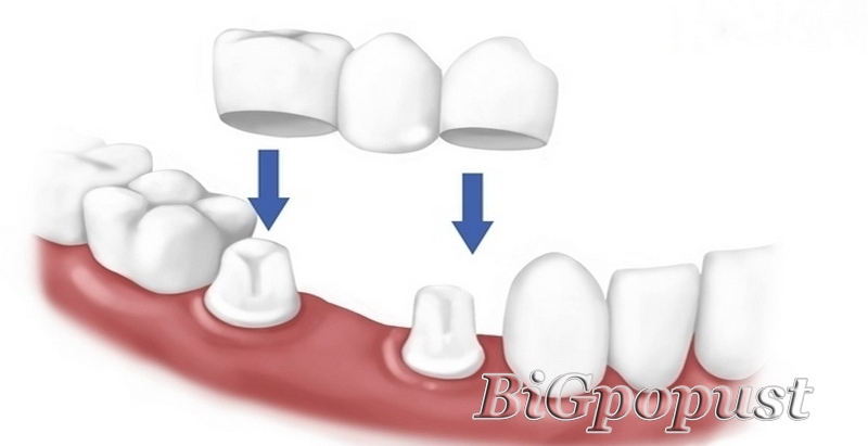 8850 rsd za izradu metalo-keramičke krunice po zubu u Stomatološkoj ordinaciji Luna Dent 2