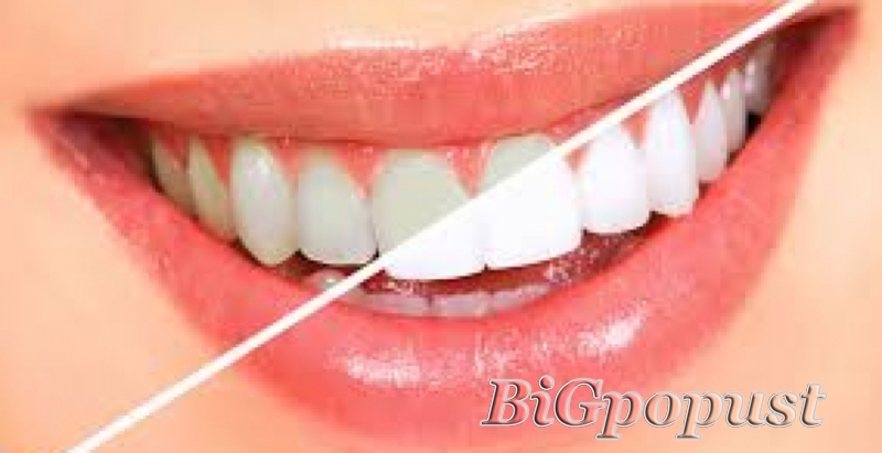 Ordinacijsko izbeljivanje zuba u stomatološkoj ordinaciji Dr D. Lopicic po promo ceni od 10000 rsd za obe vilice 2