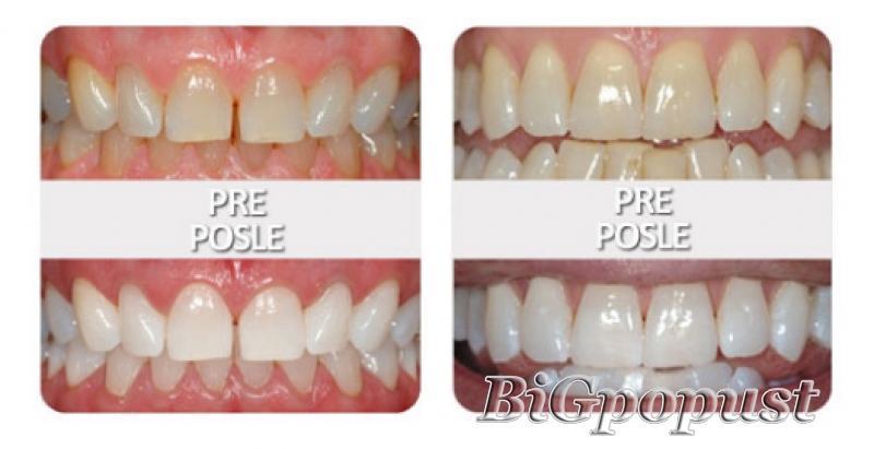Ordinacijsko izbeljivanje zuba u stomatološkoj ordinaciji Dr D. Lopicic po promo ceni od 10000 rsd za obe vilice 4